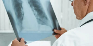 RD detecta 4,000 casos de tuberculosis al año; nueva estrategia busca erradicarla