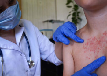Sociedad Dominicana de Infectología alerta sobre riesgo de sarampión en el país