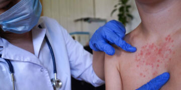 Sociedad Dominicana de Infectología alerta sobre riesgo de sarampión en el país