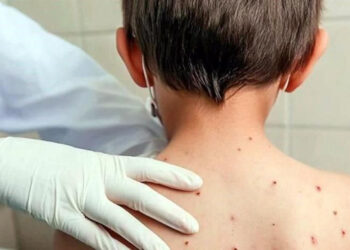Perú emite alerta epidemiológica en Perú por sarampión y polio