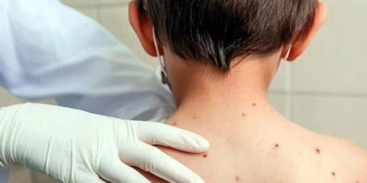 Perú emite alerta epidemiológica en Perú por sarampión y polio