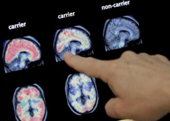 Implante cerebral devuelve el habla a paciente con ELA