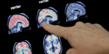 Implante cerebral devuelve el habla a paciente con ELA