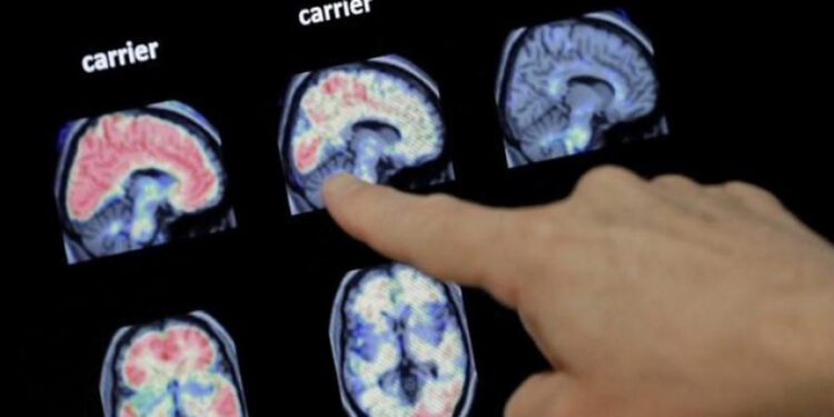 Implante cerebral devuelve el habla a paciente con ELA